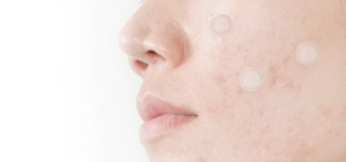 Left face with acne care patches